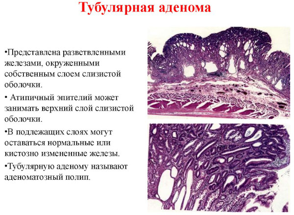 Тубулярная аденома толстой кишки с дисплазией low grade