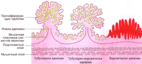 Тубулярная аденома толстой кишки с дисплазией low grade