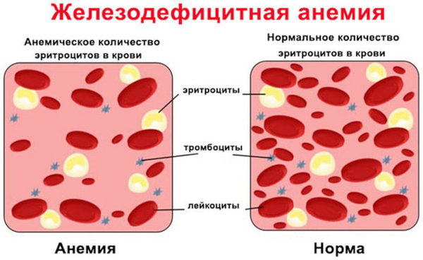 Тубулярная аденома толстой кишки с дисплазией low grade