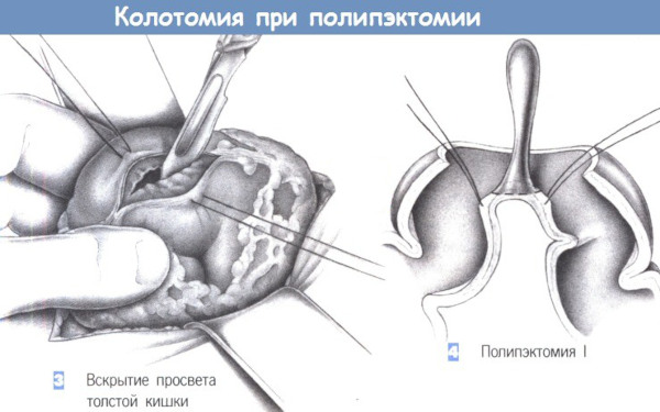 Тубулярная аденома толстой кишки с дисплазией low grade