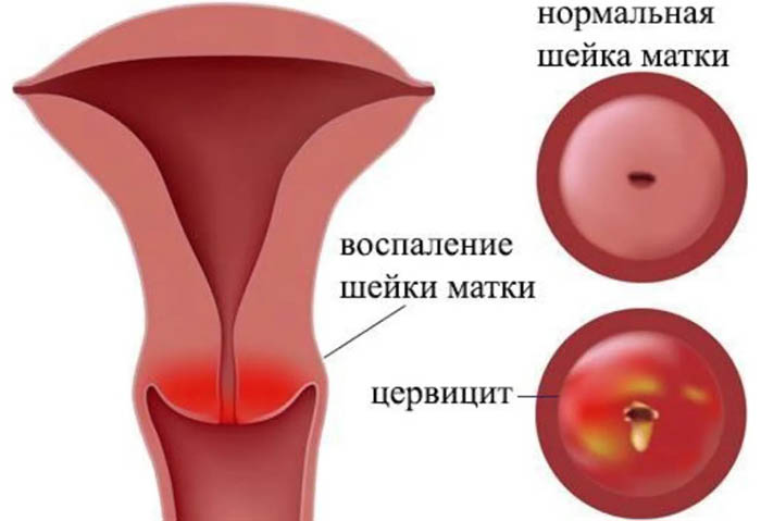 Воспаление шейки матки. Причины возникновения, симптомы, лечение