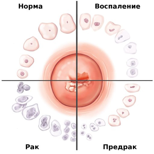 Воспаление шейки матки. Причины возникновения, симптомы, лечение