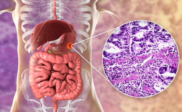 Аденокарцинома желудка. Что это, прогноз, лечение