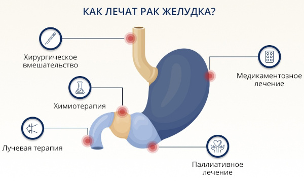 Аденокарцинома желудка. Что это, прогноз, лечение