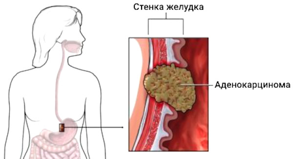 Аденокарцинома желудка. Что это, прогноз, лечение