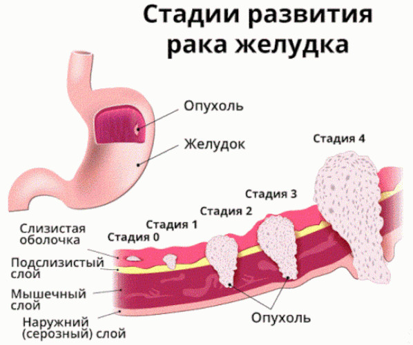 Аденокарцинома желудка. Что это, прогноз, лечение