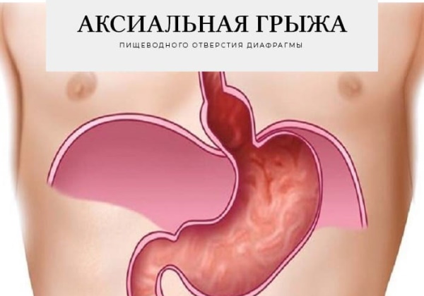 Аксиальная грыжа пищеводного отверстия диафрагмы. Что это, лечение