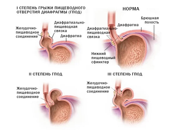 Аксиальная грыжа пищеводного отверстия диафрагмы. Что это, лечение