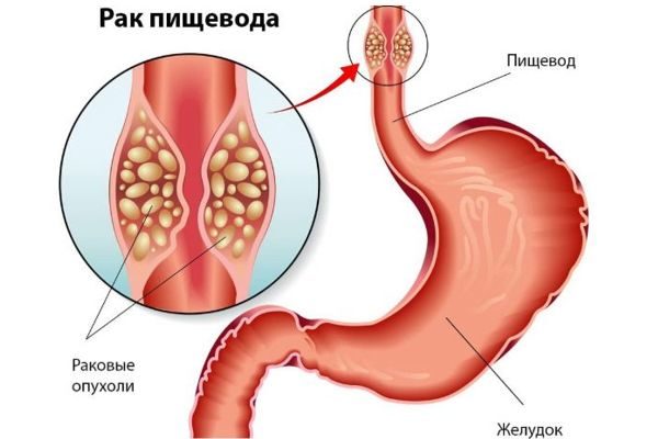 Аксиальная грыжа пищеводного отверстия диафрагмы. Что это, лечение