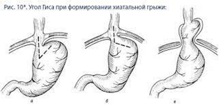 Аксиальная грыжа пищеводного отверстия диафрагмы. Что это, лечение