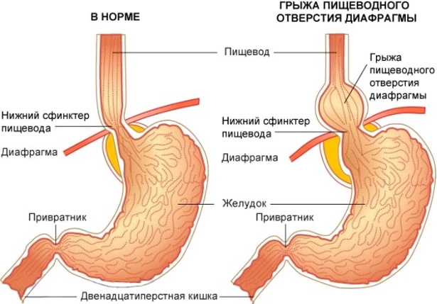 Аксиальная грыжа пищеводного отверстия диафрагмы. Что это, лечение