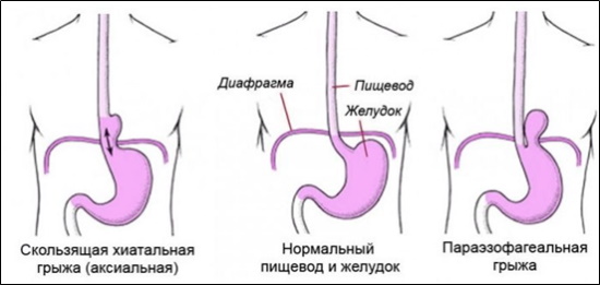 Аксиальная грыжа пищеводного отверстия диафрагмы. Что это, лечение