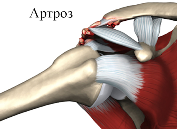 Артроз акромиально-ключичного сочленения плечевого сустава. Лечение