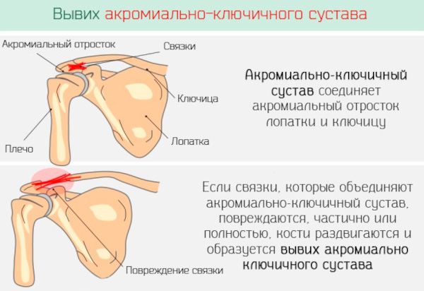 Артроз акромиально-ключичного сочленения плечевого сустава. Лечение