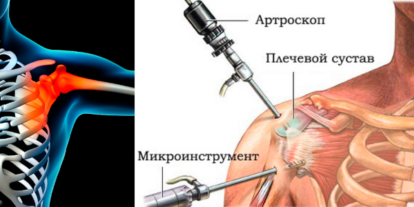 Артроз акромиально-ключичного сочленения плечевого сустава. Лечение
