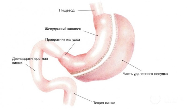 Демпинг-синдром. Что это такое в медицине