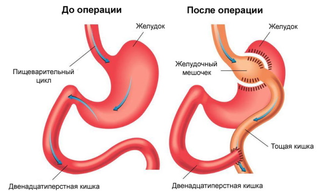 Демпинг-синдром. Что это такое в медицине