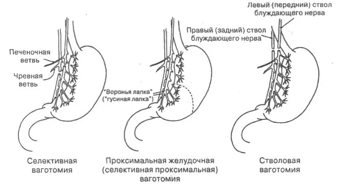 Демпинг-синдром. Что это такое в медицине