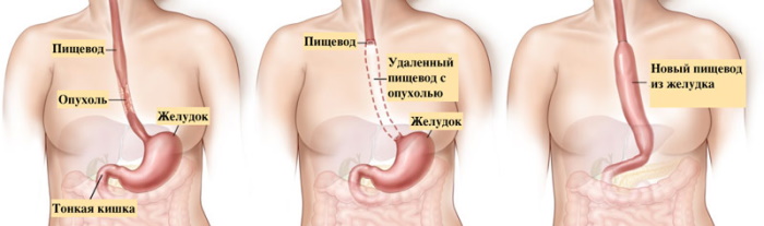 Демпинг-синдром. Что это такое в медицине