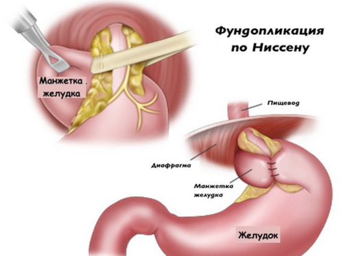 Демпинг-синдром. Что это такое в медицине