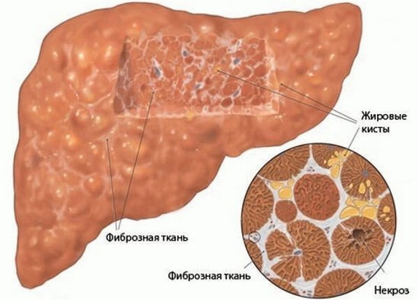 Фиброз печени. Симптомы, признаки, лечение