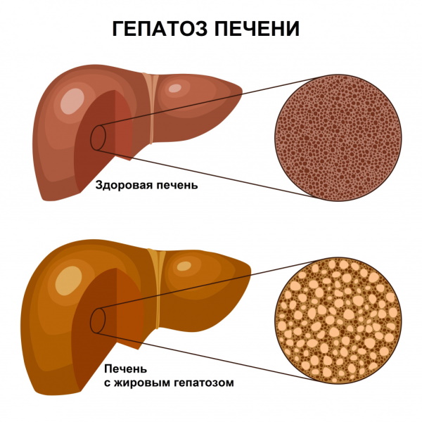 Фиброз печени. Симптомы, признаки, лечение