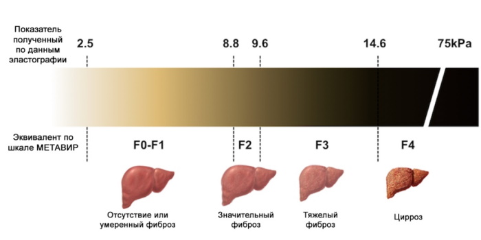 Фиброз печени. Симптомы, признаки, лечение