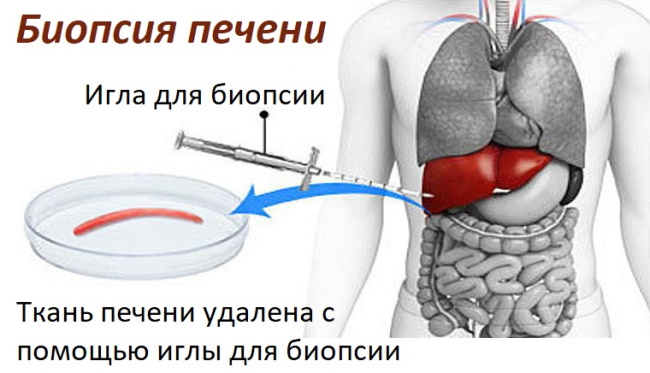 Фиброз печени. Симптомы, признаки, лечение