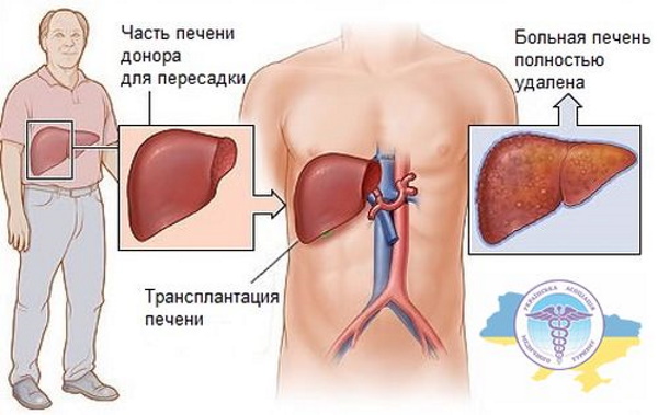 Фиброз печени. Симптомы, признаки, лечение