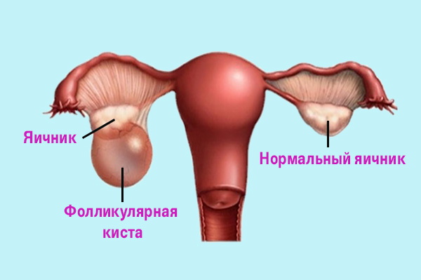 Фолликулярная киста яичника на УЗИ. Что делать, что это