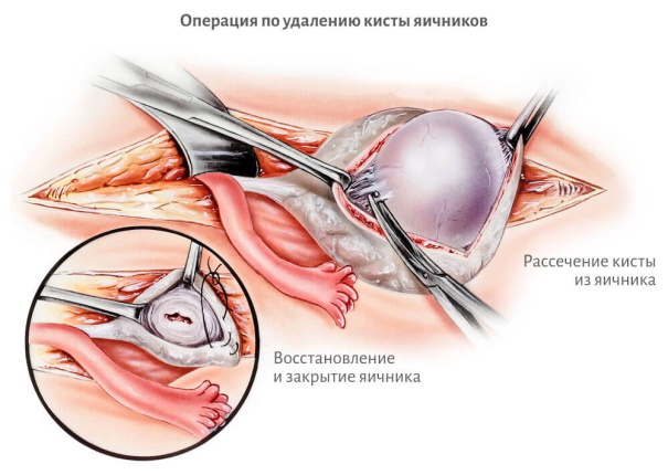 Фолликулярная киста яичника на УЗИ. Что делать, что это