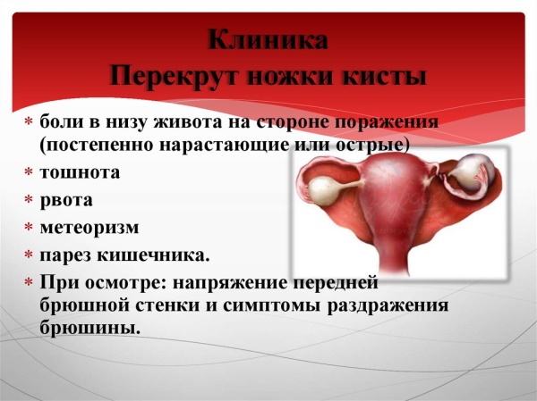 Фолликулярная киста яичника на УЗИ. Что делать, что это