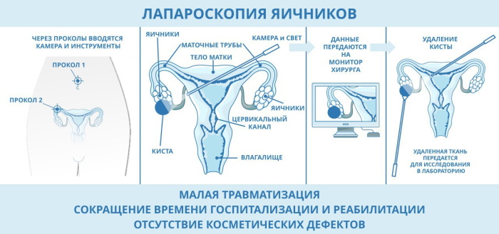 Фолликулярная киста яичника на УЗИ. Что делать, что это