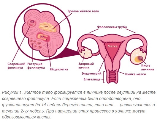 Фолликулярная киста яичника на УЗИ. Что делать, что это