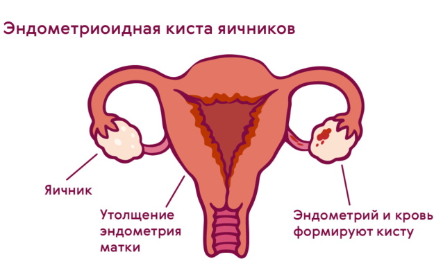 Фолликулярная киста яичника на УЗИ. Что делать, что это