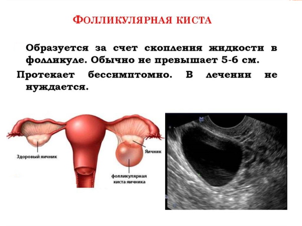 Фолликулярная киста яичника на УЗИ. Что делать, что это