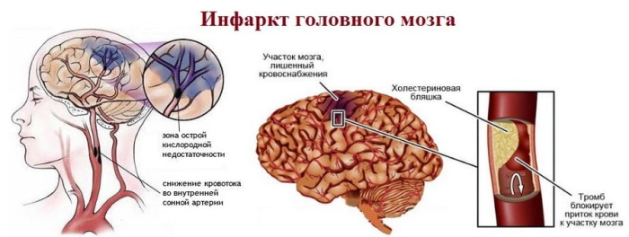 Гипертоническая (гипертензивная, ГЭ) энцефалопатия. Что это такое