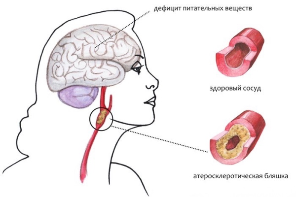 Гипертоническая (гипертензивная, ГЭ) энцефалопатия. Что это такое