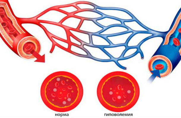 Гиповолемия. Что это такое, симптомы