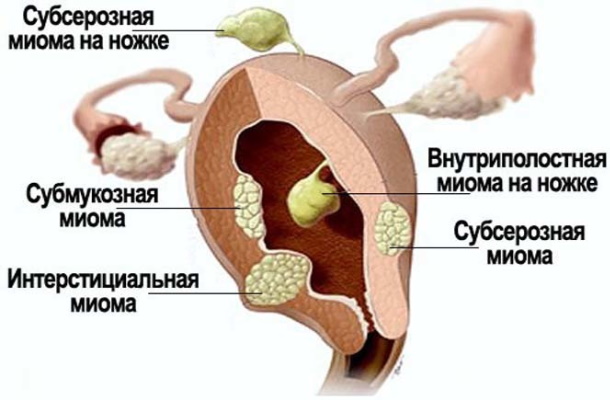 Интерстициальный узел в матке. Что это значит