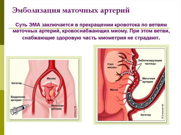 Интерстициальный узел в матке. Что это значит