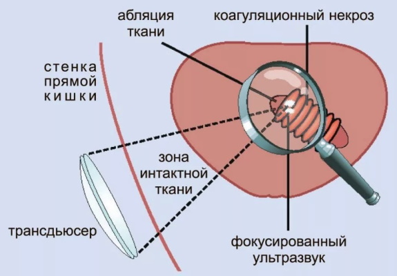 Интерстициальный узел в матке. Что это значит