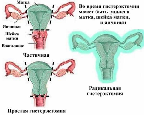 Интерстициальный узел в матке. Что это значит