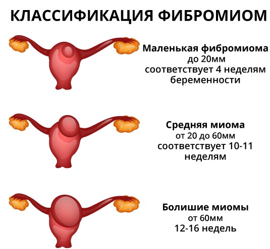 Интерстициальный узел в матке. Что это значит