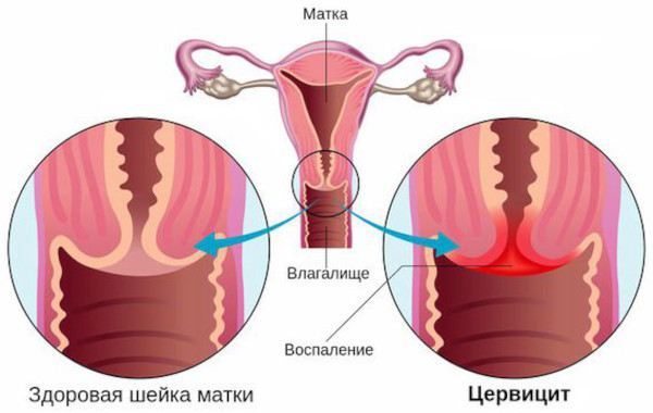 Меноррагия у женщин. Что это такое, симптомы, лечение