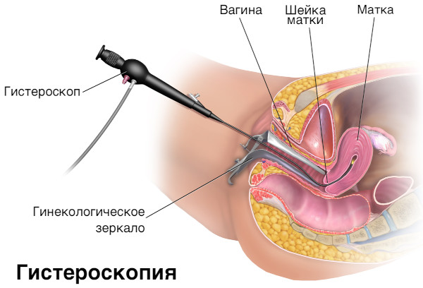 Меноррагия у женщин. Что это такое, симптомы, лечение