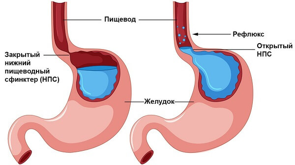 Пантопразол. Инструкция по применению, цена, отзывы