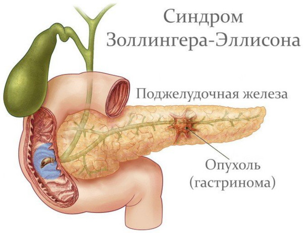 Пантопразол. Инструкция по применению, цена, отзывы