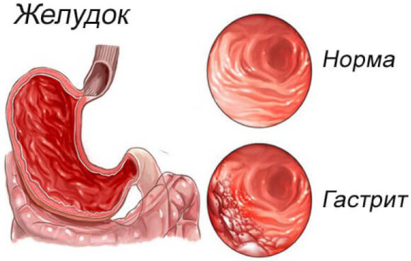 Пантопразол. Инструкция по применению, цена, отзывы