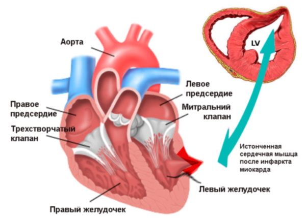 Реваскуляризация миокарда коронарная. Что это такое